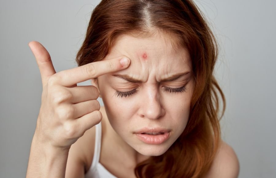 Get expert acne treatment in Dubai from top dermatologist at Eclipse