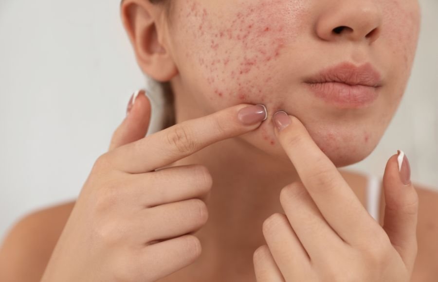 acne treatment Get expert acne treatment in Dubai from top dermatologist at Eclipse