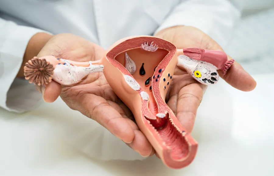 treatment for endometriosis if you have any symptoms Get expert Polycystic Ovary Syndrome (PCOS) treatment in Dubai