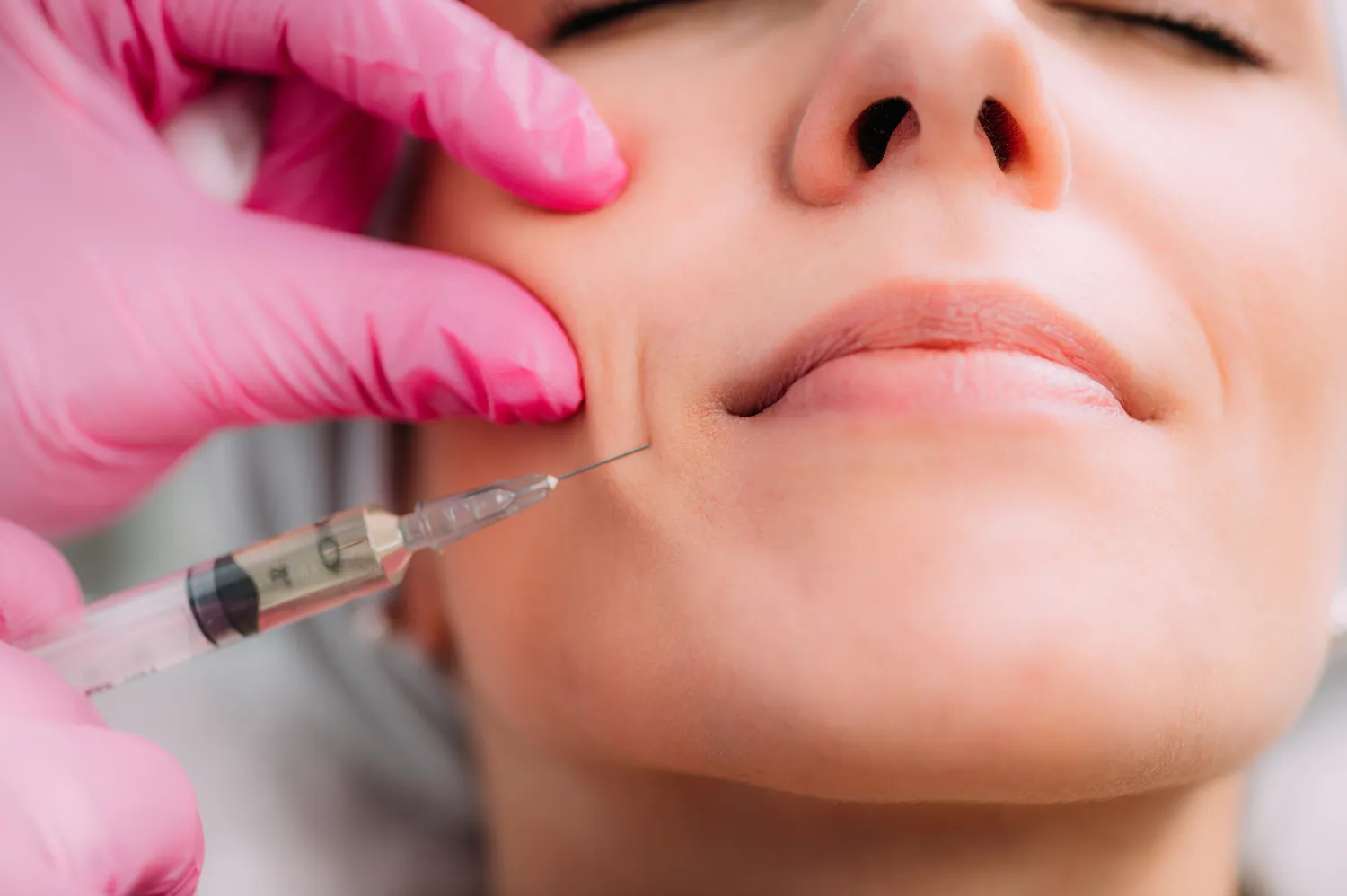 facial filler injection
