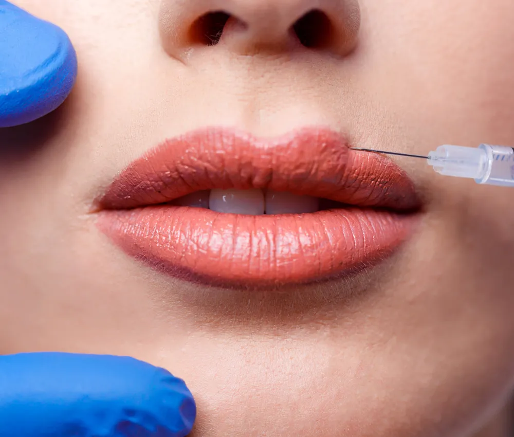 russian lip filler in dubai pic_6 russian lip filler in dubai pic_6